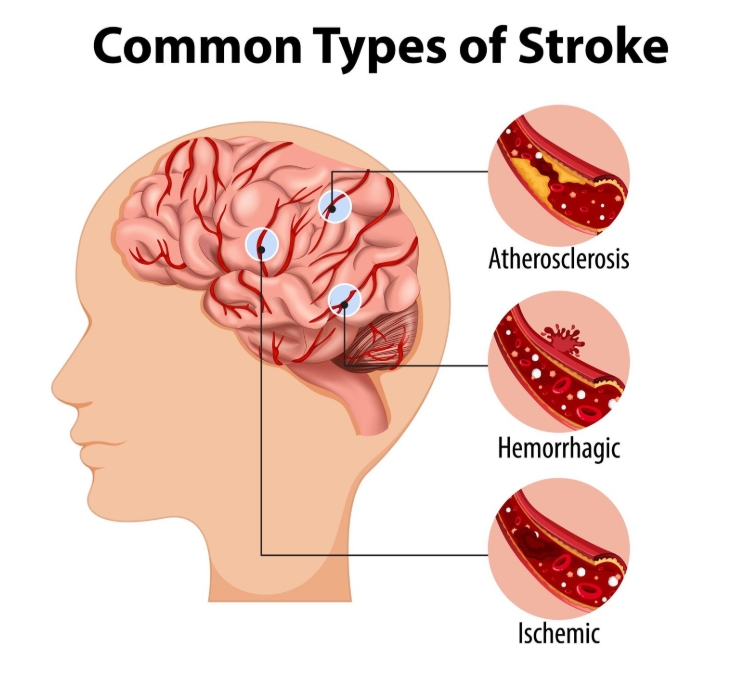 BRAIN SPECIAILIST IN HENNUR and KOTHANUR
